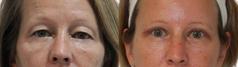 Melanie L. Aya-ay, MD eyelid lift result — Tampa, FL