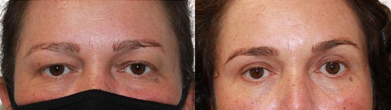 Melanie L. Aya-ay, MD eyelid lift result — Tampa, FL