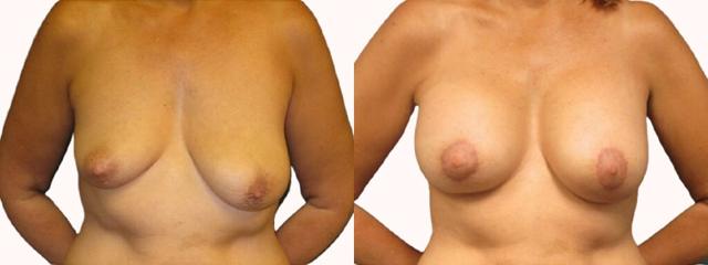 Breast Lift result at Melanie L. Aya-ay, MD in Tampa, FL