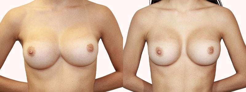 Melanie L. Aya-ay, MD breast augmentation revision result — Tampa, FL