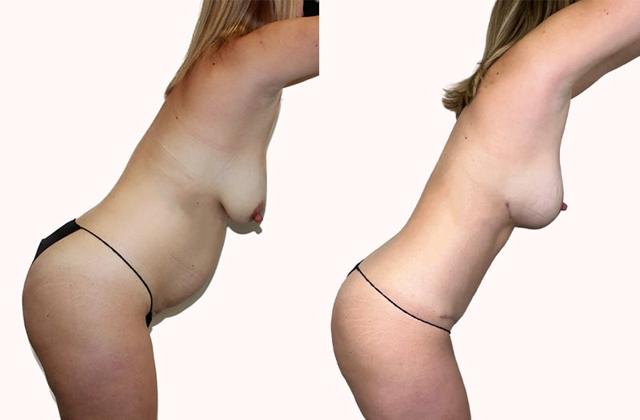 Mommy Makeover result at Melanie L. Aya-ay, MD in Tampa, FL