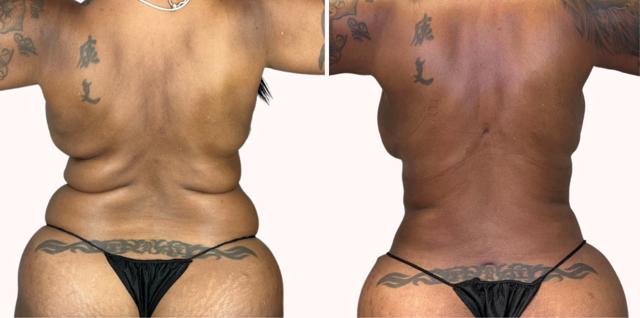 Liposuction result at Melanie L. Aya-ay, MD in Tampa, FL