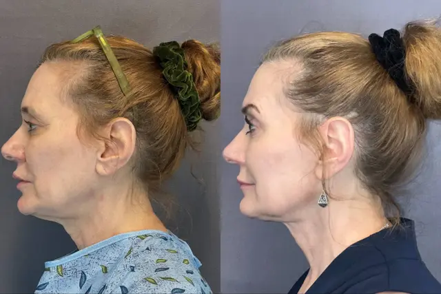 Facelift result at Austin Face & Body in Austin, TX
