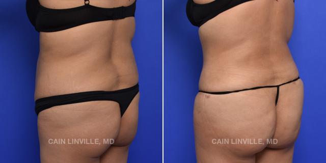 Brazilian Butt Lift result at Austin Face & Body in Austin, TX