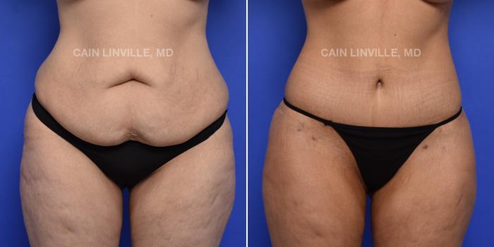 Austin Face & Body tummy tuck result — Austin, TX