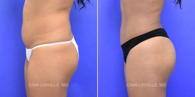Brazilian Butt Lift result at Austin Face & Body in Austin, TX