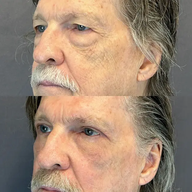 Blepharoplasty result at Austin Face & Body in Austin, TX