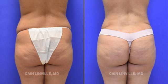 Brazilian Butt Lift result at Austin Face & Body in Austin, TX