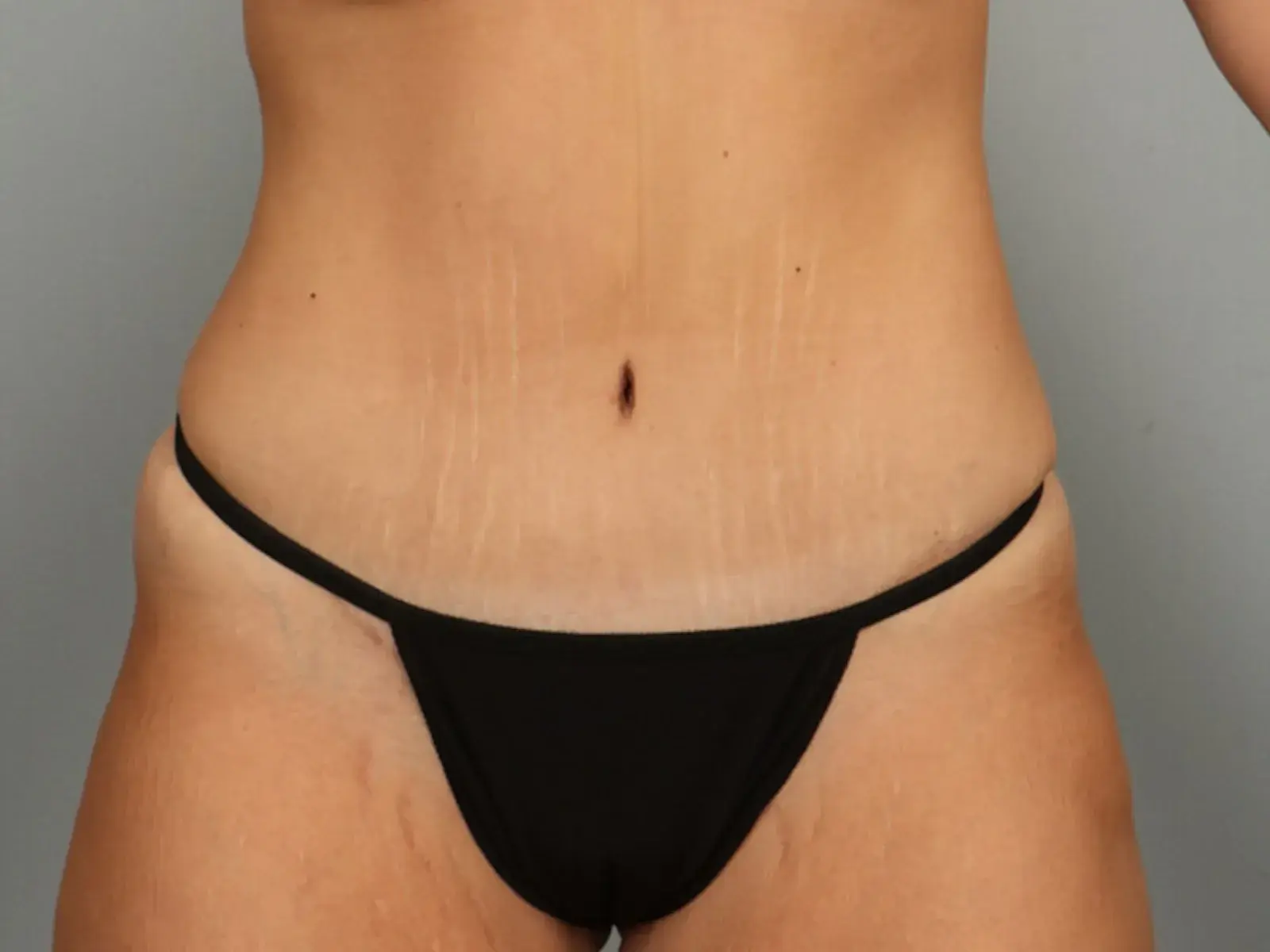 Austin Face & Body tummy tuck after — Austin, TX