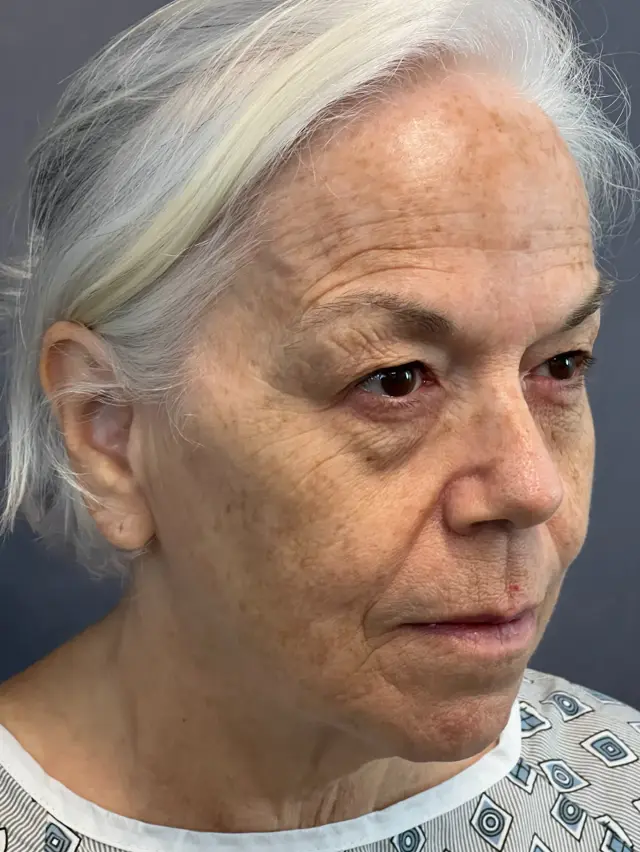 Blepharoplasty before at Austin Face & Body in Austin, TX