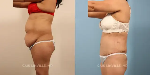 Tummy Tuck result at Austin Face & Body in Austin, TX