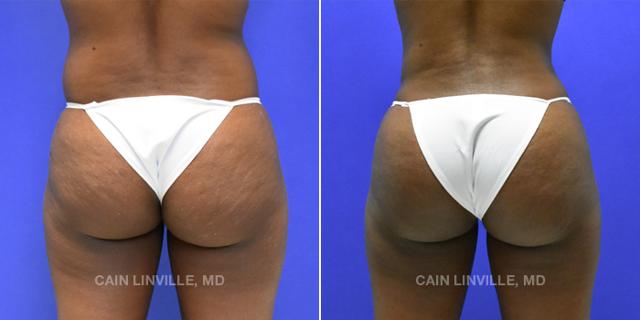 Brazilian Butt Lift result at Austin Face & Body in Austin, TX