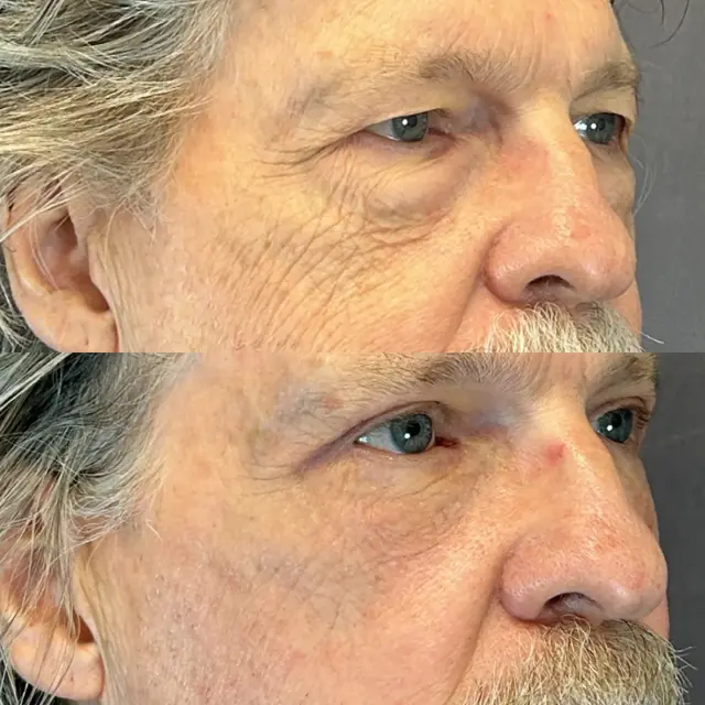 Blepharoplasty result at Austin Face & Body in Austin, TX