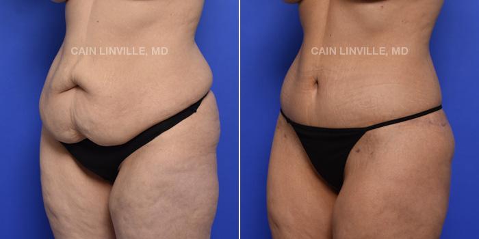Austin Face & Body tummy tuck result — Austin, TX
