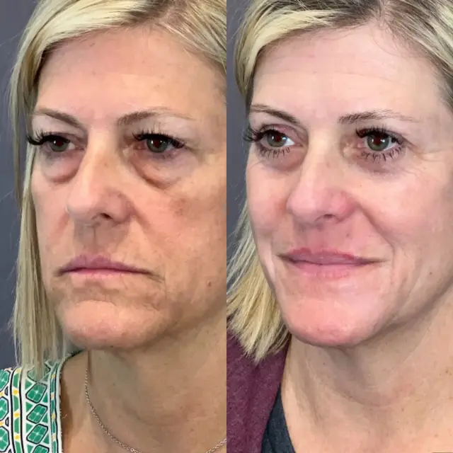 Blepharoplasty result at Austin Face & Body in Austin, TX