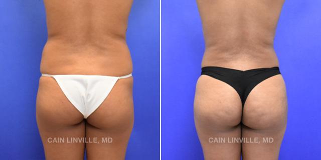 Brazilian Butt Lift result at Austin Face & Body in Austin, TX