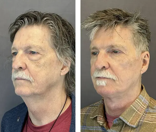 Facelift result at Austin Face & Body in Austin, TX