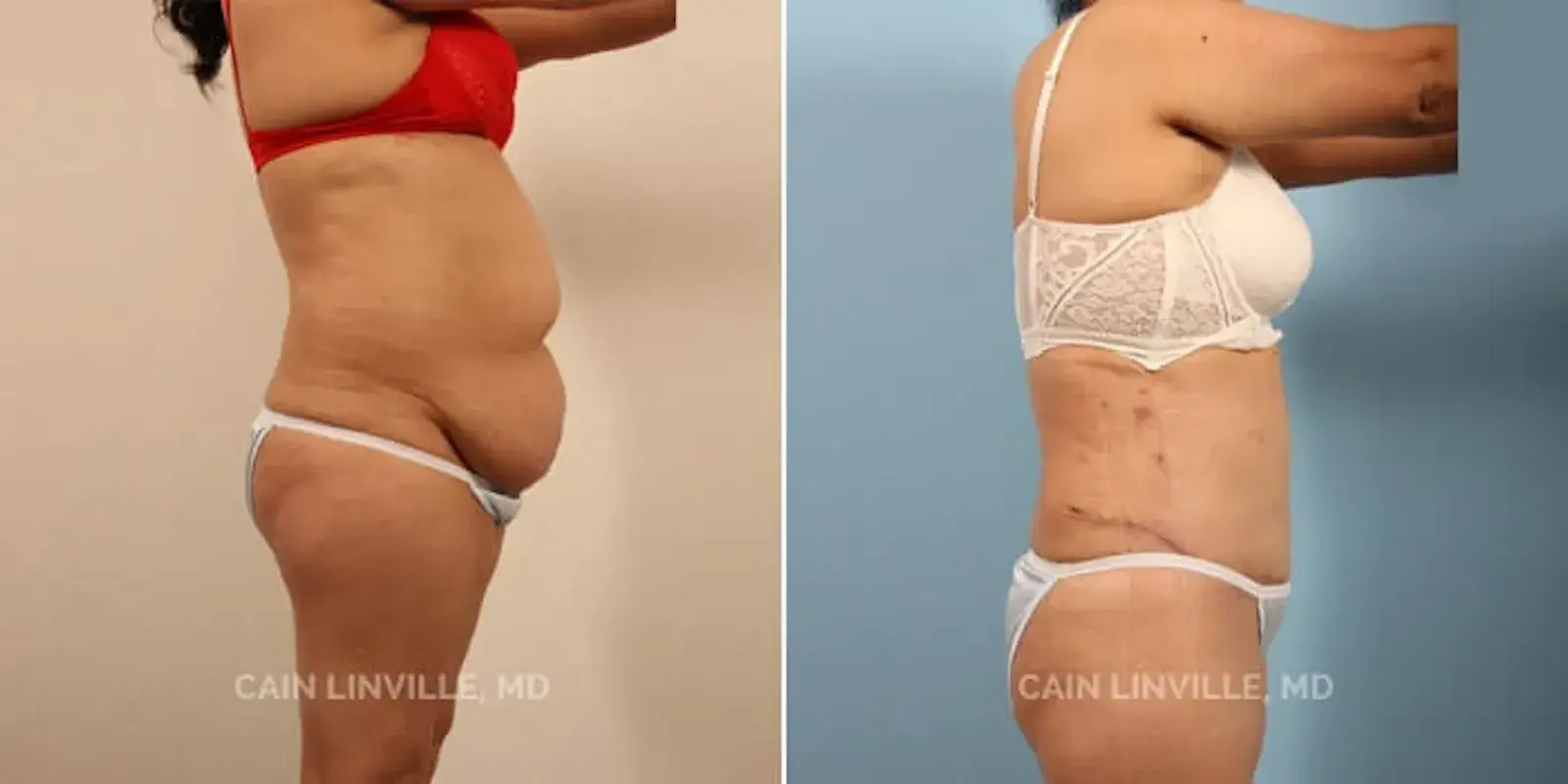 Austin Face & Body tummy tuck result — Austin, TX