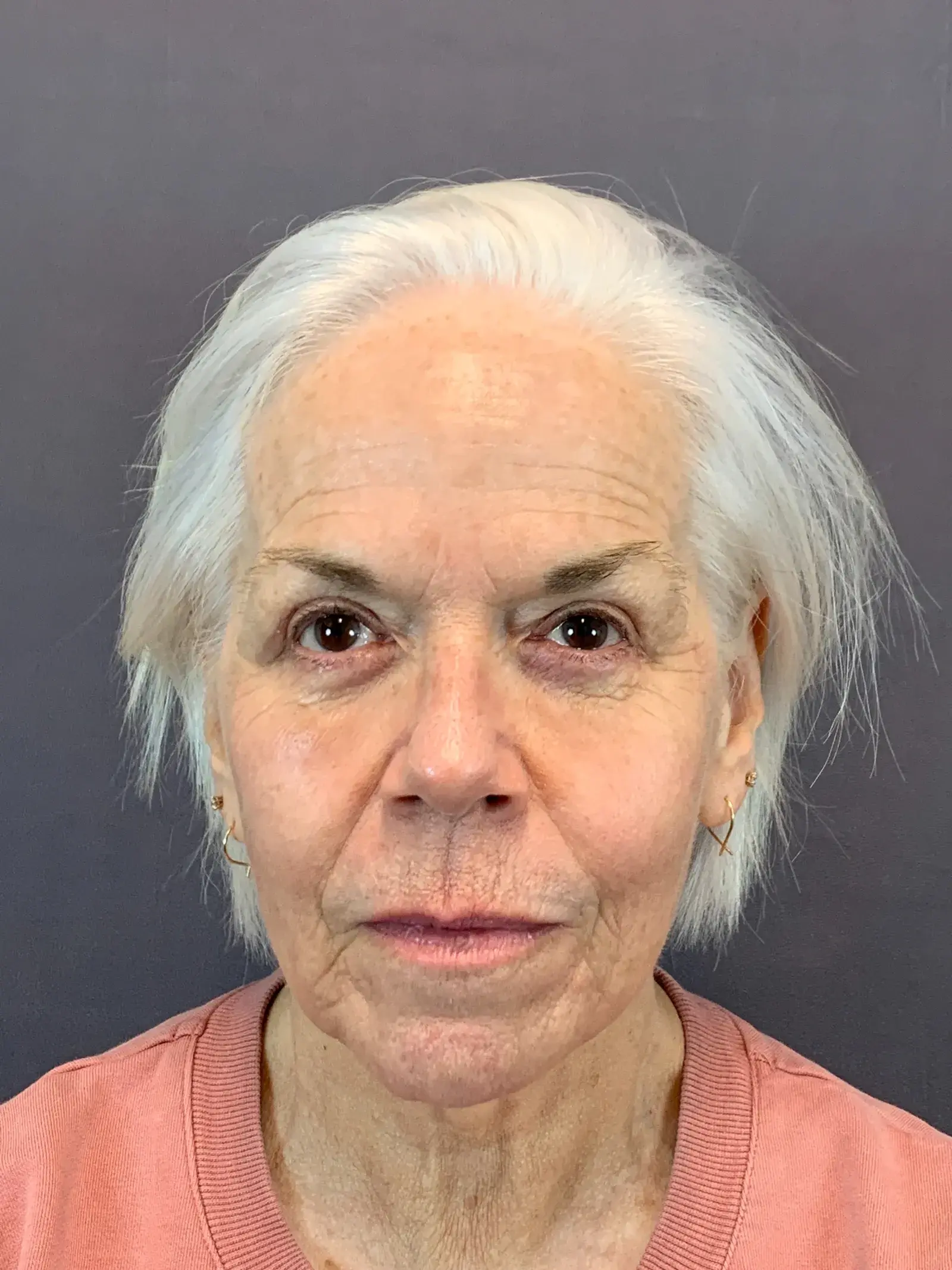 Austin Face & Body eyelid lift after — Austin, TX