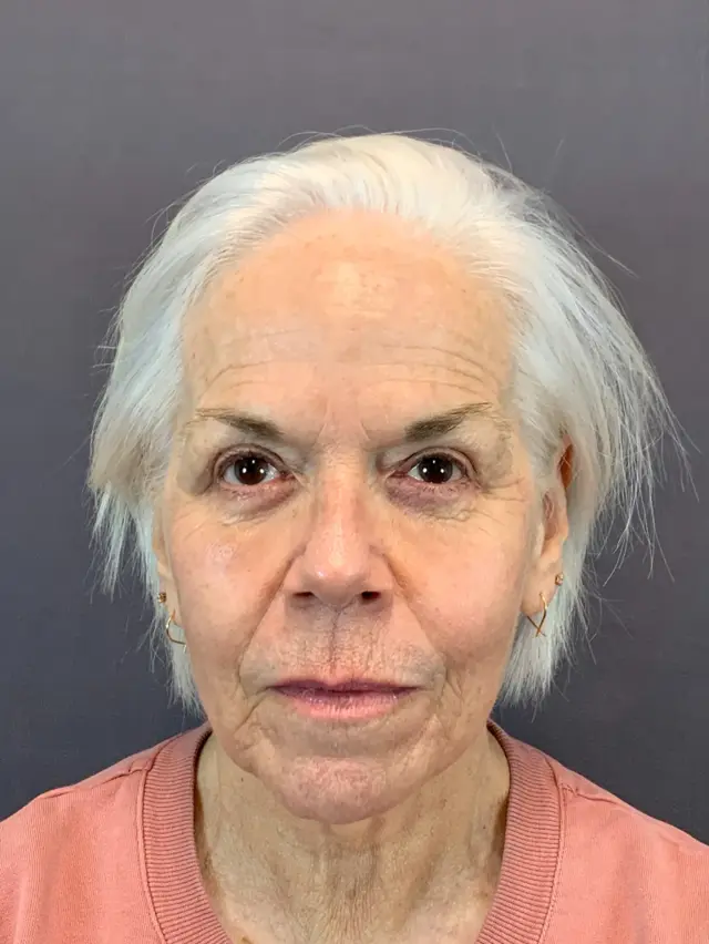 Blepharoplasty after at Austin Face & Body in Austin, TX