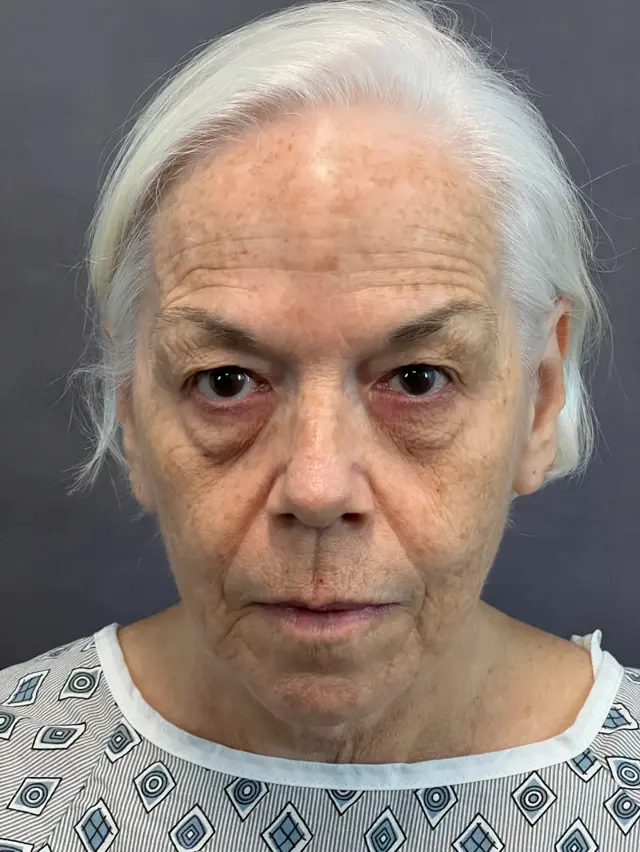 Blepharoplasty before at Austin Face & Body in Austin, TX