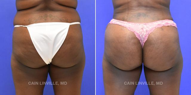 Brazilian Butt Lift result at Austin Face & Body in Austin, TX