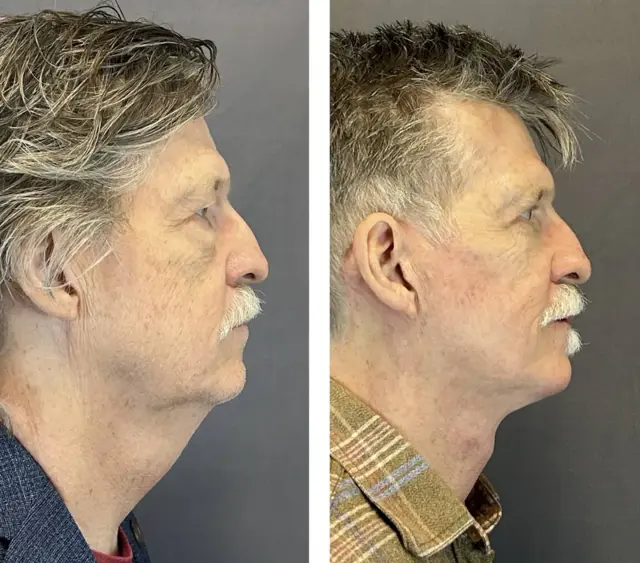 Facelift result at Austin Face & Body in Austin, TX
