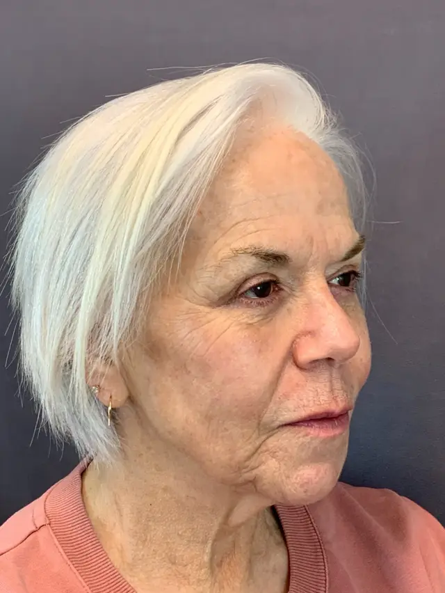 Blepharoplasty after at Austin Face & Body in Austin, TX
