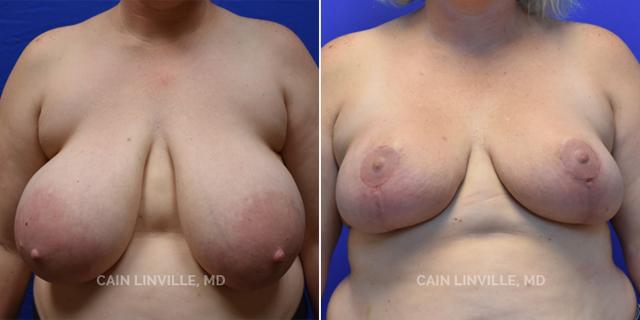 Breast Reduction result at Austin Face & Body in Austin, TX