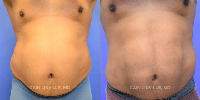 Liposuction result at Austin Face & Body in Austin, TX