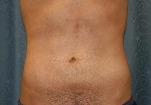 Khattab Sherif, MD liposuction after — Torrance, CA