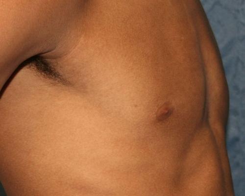 Khattab Sherif, MD gynecomastia after — Torrance, CA