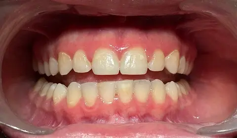 Smile Makeover before at North Scottsdale Dentistry in Scottsdale, AZ