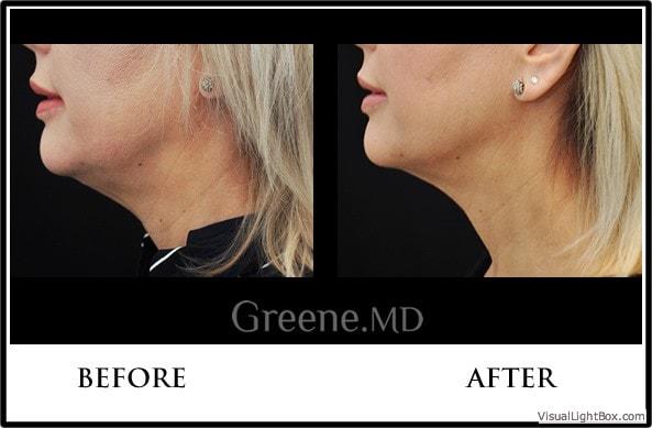 Dr. Ryan Greene kybella result — Weston, FL