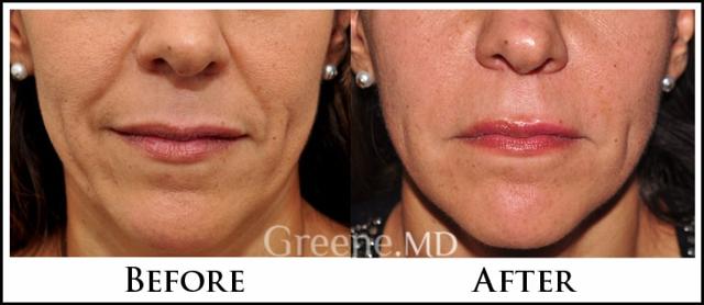 Jawline Filler result at Dr. Ryan Greene in Weston, FL