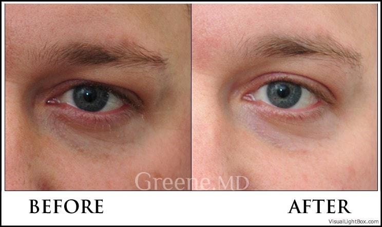 Dr. Ryan Greene skin tightening result — Weston, FL