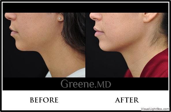 Dr. Ryan Greene kybella result — Weston, FL