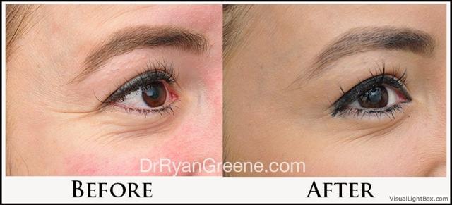 Botox result at Dr. Ryan Greene in Weston, FL