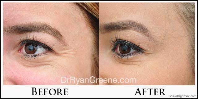 Botox result at Dr. Ryan Greene in Weston, FL