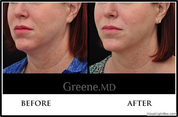 Kybella result at Dr. Ryan Greene in Weston, FL