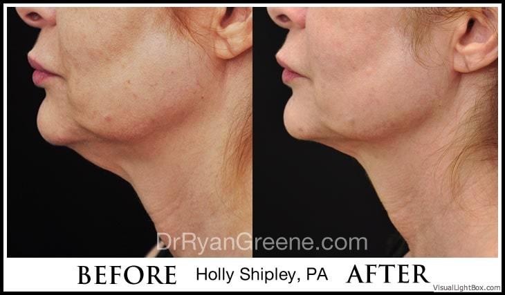 Dr. Ryan Greene kybella result — Weston, FL