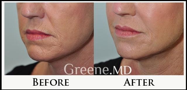 Jawline Filler result at Dr. Ryan Greene in Weston, FL