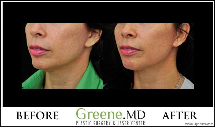 Dr. Ryan Greene skin tightening result — Weston, FL