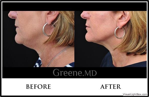 Dr. Ryan Greene kybella result — Weston, FL