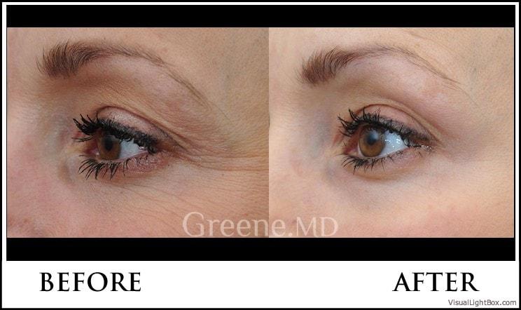 Dr. Ryan Greene skin tightening result — Weston, FL