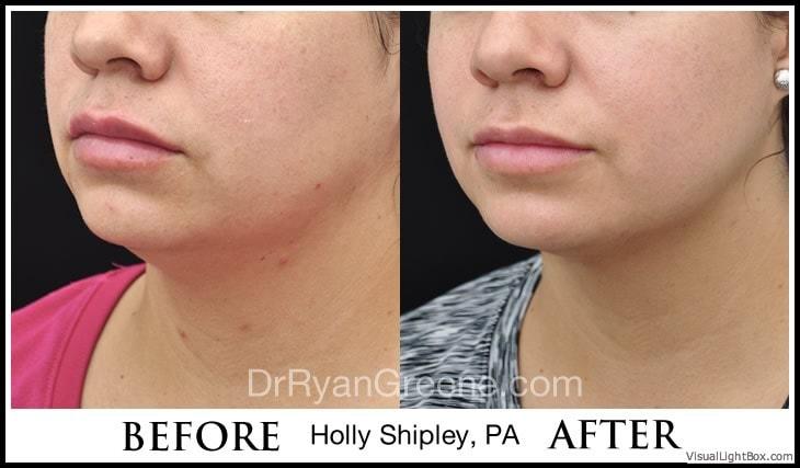 Dr. Ryan Greene kybella result — Weston, FL