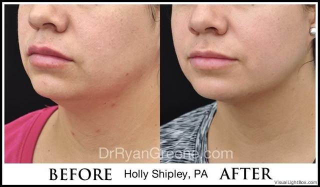 Kybella result at Dr. Ryan Greene in Weston, FL