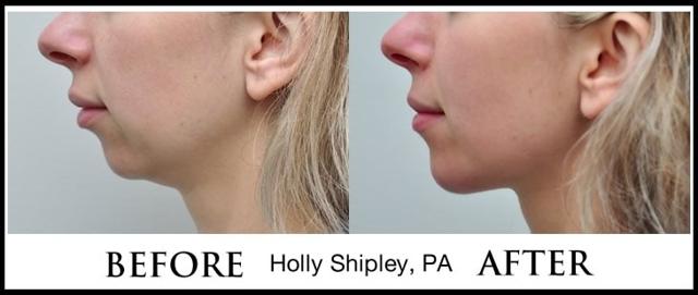 Juvederm result at Dr. Ryan Greene in Weston, FL