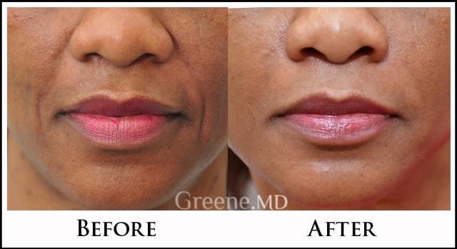 Jawline Filler result at Dr. Ryan Greene in Weston, FL