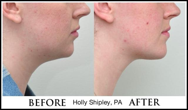 Jawline Filler result at Dr. Ryan Greene in Weston, FL